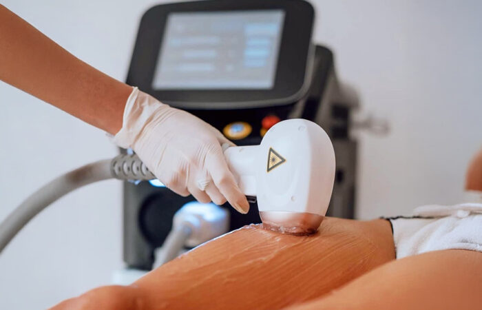 Lazer Epilasyonda Sonuç Alamamanızın Tek Nedeni Bu Olabilir (Buz Lazer Gerçeği)