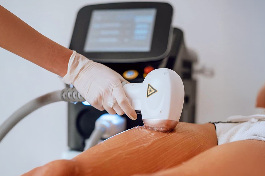 Lazer Epilasyonda Sonuç Alamamanızın Tek Nedeni Bu Olabilir (Buz Lazer Gerçeği)