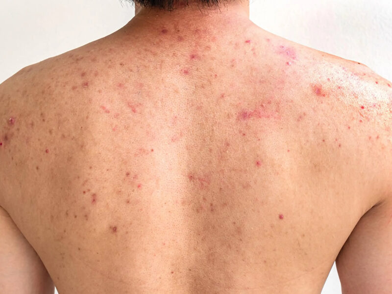 Sırt Sivilceleri ve Lekeleri