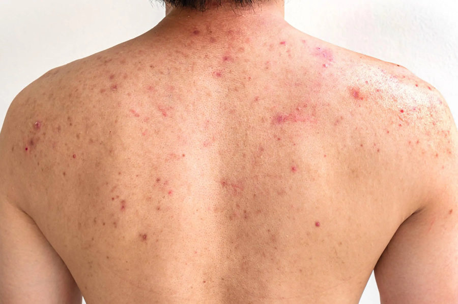 Sırt Sivilceleri ve Lekeleri